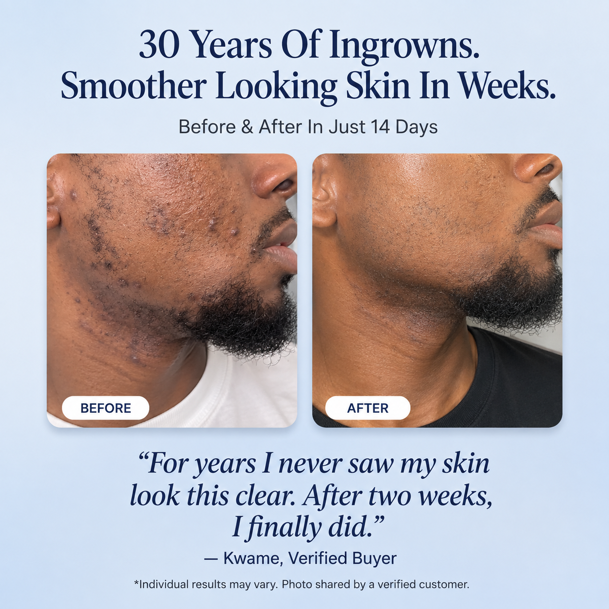 ✨ SKAVIX Ingrown Hair Roll-On Serum – Smoothing Care for Razor Bumps, Trapped Hairs & Post-Shave Irritation ✨
