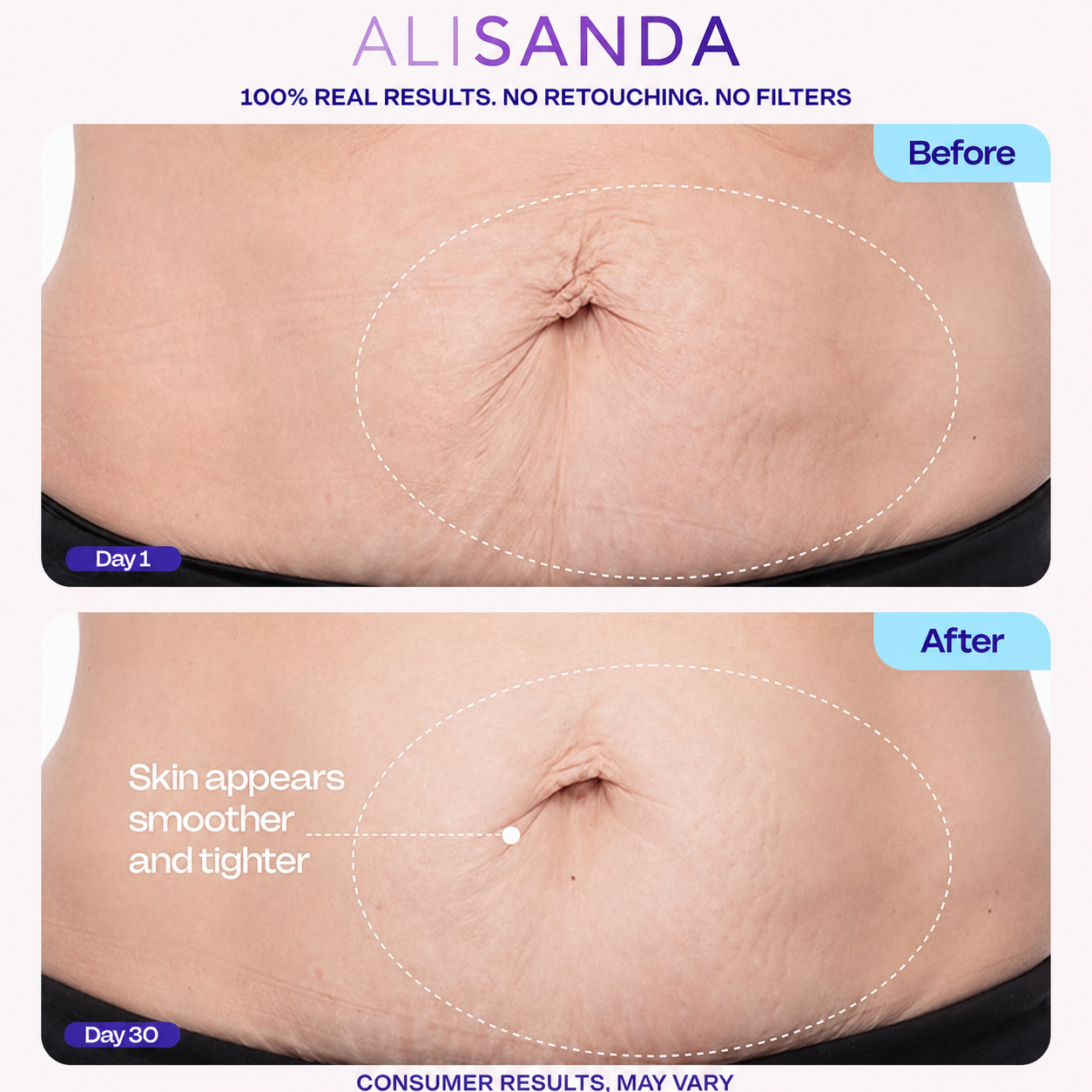 💜 ALISANDA Tighten & Smooth Belly Cream – Firming, Stretch Mark & Loose Skin Care ✨